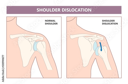 Shoulder dislocation X-ray joint arm sport lesion slap hill sachs tear torn traumatic pain broken cuff sling bone falls tendon subluxed head range of motion Superior overuse clavicle separated therapy