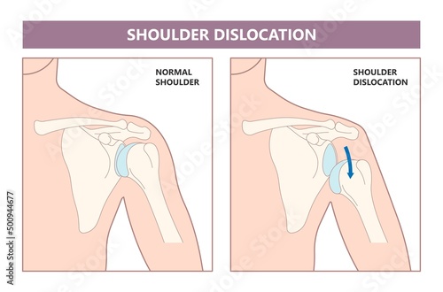 Shoulder dislocation X-ray joint arm sport lesion slap hill sachs tear torn traumatic pain broken cuff sling bone falls tendon subluxed head range of motion Superior overuse clavicle separated therapy photo