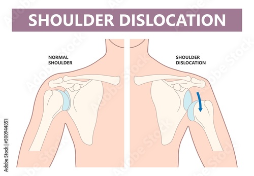 Shoulder dislocation X-ray joint arm sport lesion slap hill sachs tear torn traumatic pain broken cuff sling bone falls tendon subluxed head range of motion Superior overuse clavicle separated therapy photo