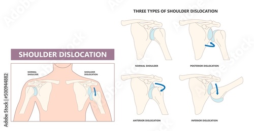 Shoulder dislocation X-ray joint arm sport lesion slap hill sachs tear torn traumatic pain broken cuff sling bone falls tendon subluxed head range of motion Superior overuse clavicle separated therapy photo