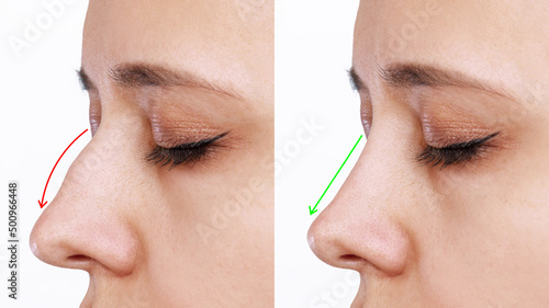 Canvas Print A profile of woman's face with nose before and after rhinoplasty isolated on a white background