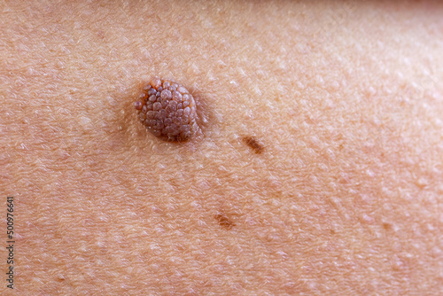 Oncology mole big wart on old woman. Concept dermatology skin cancer diseases malignant tumor photo