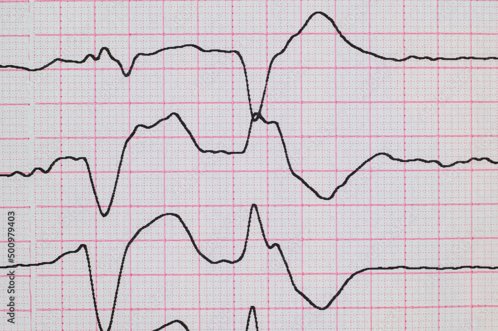 ECG with rhythm disturbance and ventricular extrasystole close-up