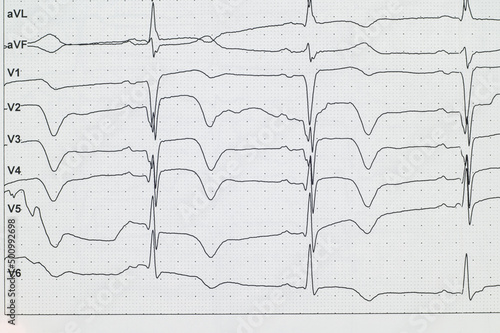 ECG. Myocardial infarctionon ECG. Angina.Chest pain. Close-up.