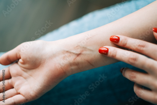 Young caucasian woman showing hand with fresh cuts after suicide attempt, close-up.