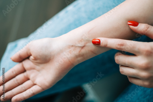 Fotografia Young caucasian woman showing hand with fresh cuts after suicide attempt, close-up
