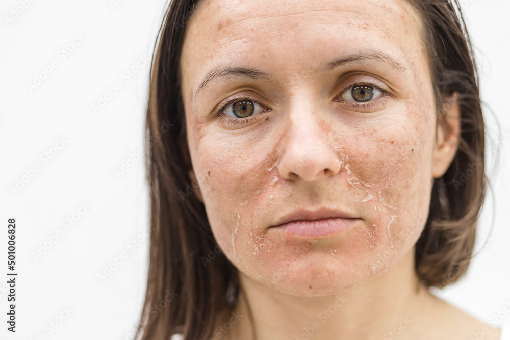 Cropped photo of woman with dry skin over white background. Cropped photo of woman with dry skin over white background.