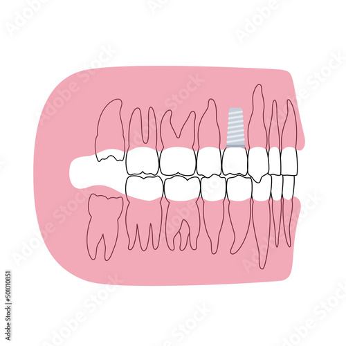 Dental implant procedure