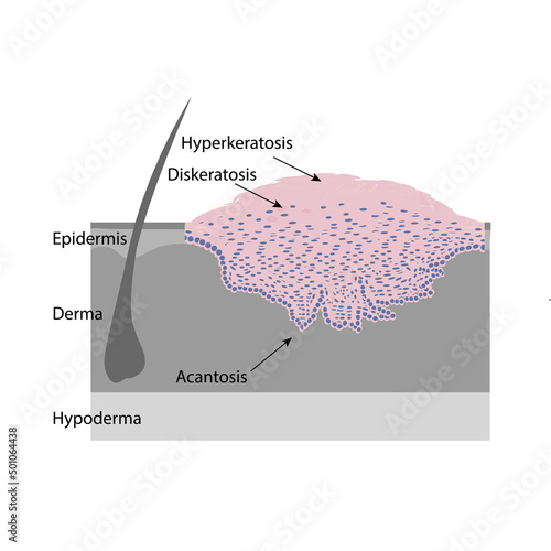 Scheme of skin papilloma, histology, vetkor