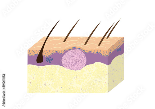 Scheme of skin fibroma, histology, vetcor