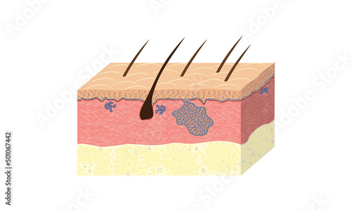 Basalioma, skin cancer, histology, vector