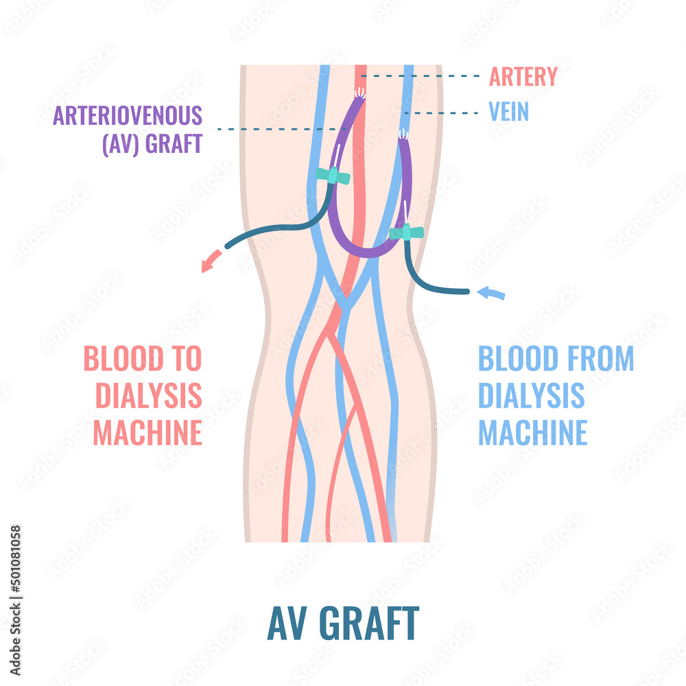 Arteriovenous dialysis shunt graft catheter for hemodialysis sessions. Arm with surgically inserted tube connecting artery to vein under skin. Medical vector illustration. - obrazy, fototapety, plakaty 