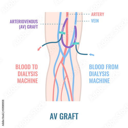 Arteriovenous dialysis shunt graft catheter for hemodialysis sessions. Arm with surgically inserted tube connecting artery to vein under skin. Medical vector illustration.