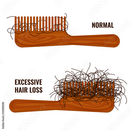 Hairbrush with hair stuck in the teeth. Hair strands on a comb. Excessive hair fall problem. Alopecia symptom concept. Vector illustration.