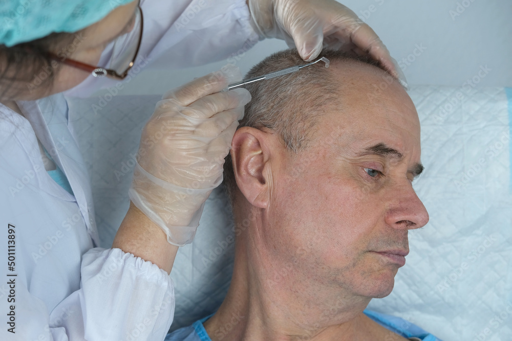 close-up trichologist treats patient, bald mature man with alopecia in hair growth clinic, anti-aging treatments for balding men. concept of hair transplant procedures for men, selective focus close-up trichologist treats patient, bald mature man with alopecia in hair growth clinic, anti-aging treatments for balding men. concept of hair transplant procedures for men, selective focus