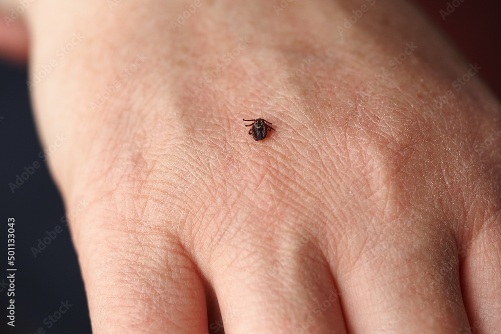Naklejka premium Ixodid, encephalitic live tick on the human body close-up, macro photography.