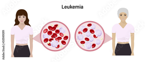 Leukemia. The difference of blood leukemia and normal blood. Healthy woman and woman with leukemia.