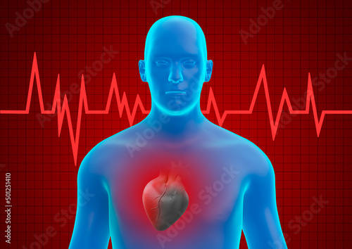 Ταπετσαρία acute myocardial infarction caused by a clot that blocks blood flow to the heart