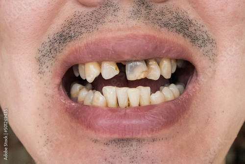 A man with crooked and yellow teeth.