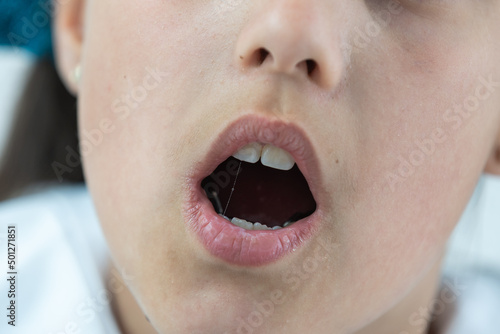 a little girl with a shifted dentition demonstrates her teeth