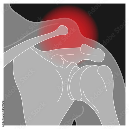 Separation dislocation the AC joint fall shoulder bump bruise torn cuff tear nerve bone broken Trauma pain arc arm sport medicine Neer FOOSH test Grade X ray Brace arthroscopy recovery range of motion