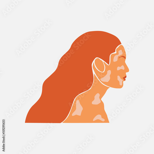 Abstract silhouette of beauty redhead woman with white pigmentation . Support awareness about chronic skin disorder. World Vitiligo day. Diversity tolerance. Fashion paper cut vector illustration