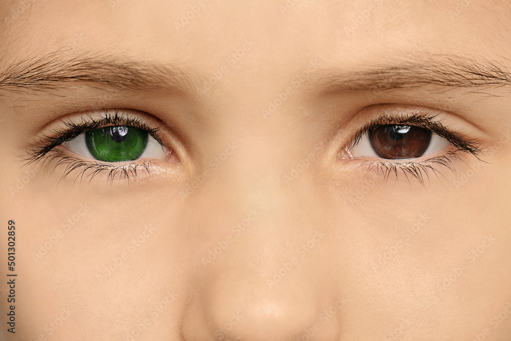 Fototapeta premium Little girl with different colors of eyes, closeup. Heterochromia iridis