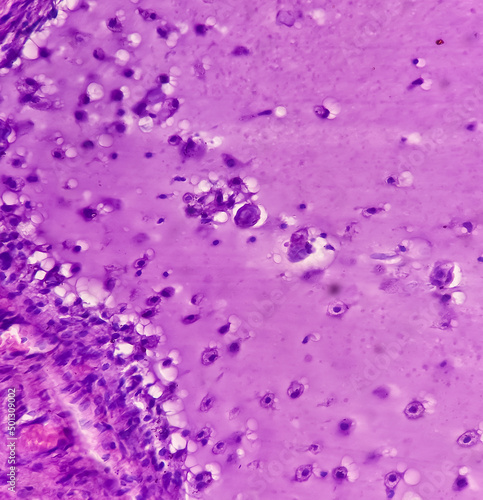 Fibroepithelial polyp of tongue  show fibrocollagenous tissue lined by stratified squamous epithelium  no malignancy  Tongue polyp.