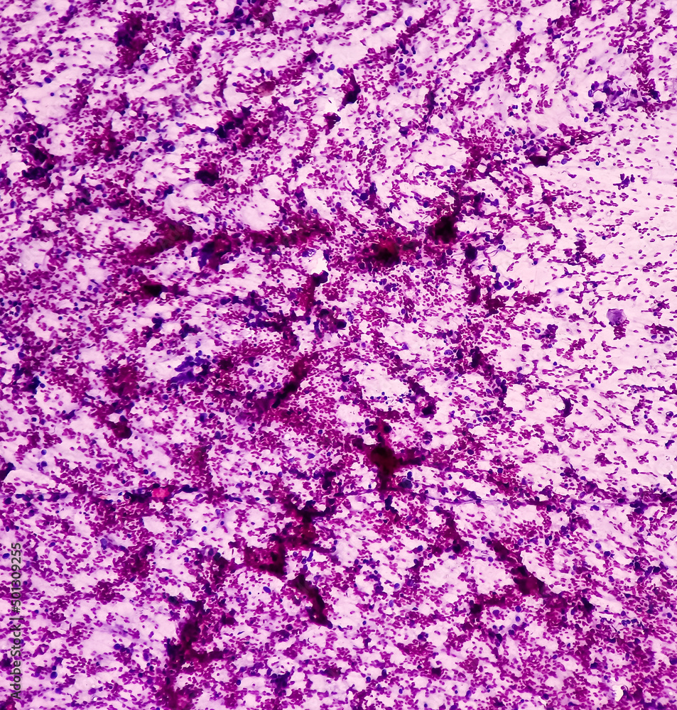 Hilar cancer, Hilar Enlargement, lung cancer, small cell carcinoma, malignant cells, non- hodgkin lymphoma, show atypical small round cells, granular salt pepper chromatin.