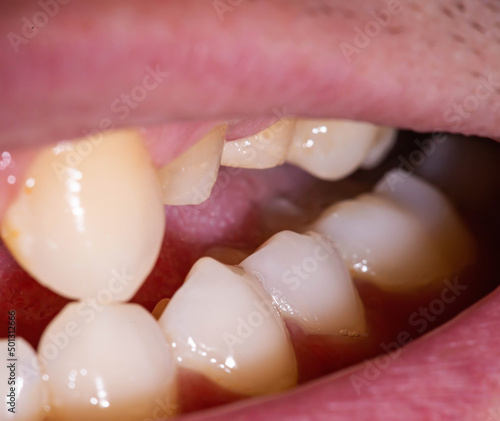 Grind teeth under a metal-ceramic crown in a man's mouth. Dental prosthetics in dental orthopedics, macro