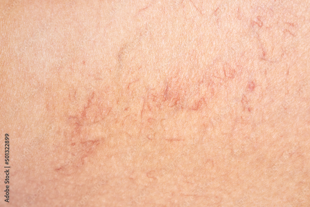 Fototapeta premium Removal of varicose veins on the legs. Medical inspection and treatment of Telangiectasia. Phlebeurysm.