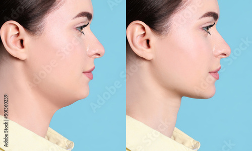 Double chin problem. Collage with photos of young woman before and after plastic surgery procedure on turquoise background