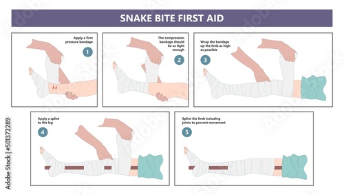 Snake Bite First Aid care non venomous anti venom serum hand leg king cobra treat kit death injury help safe call pain blood healing prevent coral fangs step poster grabbing splint limb sign tongs