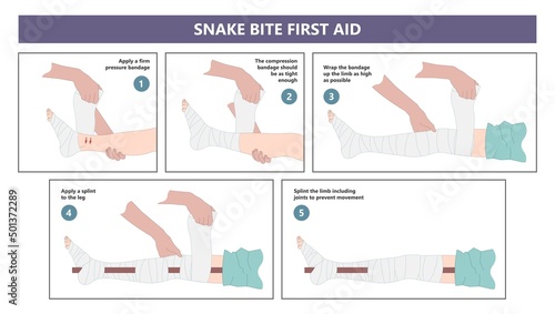 Snake Bite First Aid care non venomous anti venom serum hand leg king cobra treat kit death injury help safe call pain blood healing prevent coral fangs step poster grabbing splint limb sign tongs photo