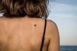 Close-up of Female Back with Large Freckles and Small Freckles with Black Bikini Strap in front of the Sea. Dermatology Concept