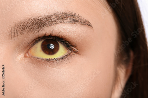 Young woman with yellow eyes, closeup. Hepatitis symptom
