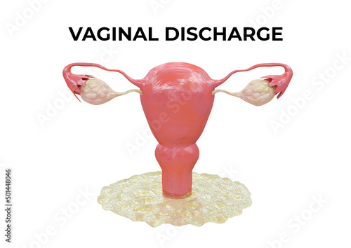 Принти на полотні Vaginal discharge is excess fluid and cells from the vagina that ranges from whi