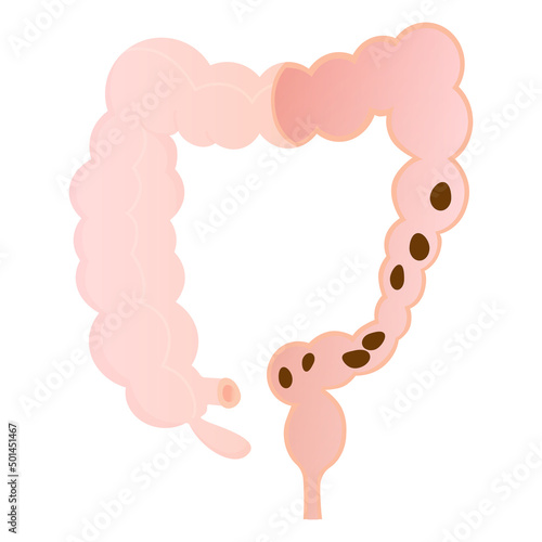 Vector illustration of convulsive constipation.