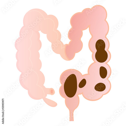 Vector illustration of flaccid constipation.