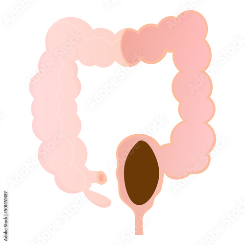 Vector illustration of rectal constipation.