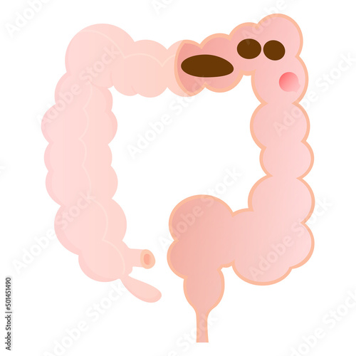 Vector illustration of organic constipation.