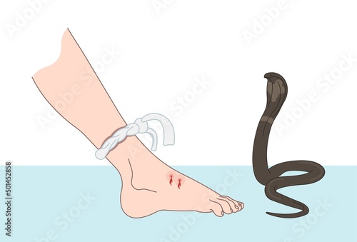 Snake Bite First Aid care non venomous anti venom serum hand leg king cobra treat kit death injury help safe call pain blood healing prevent coral fangs step poster grabbing splint limb sign tongs