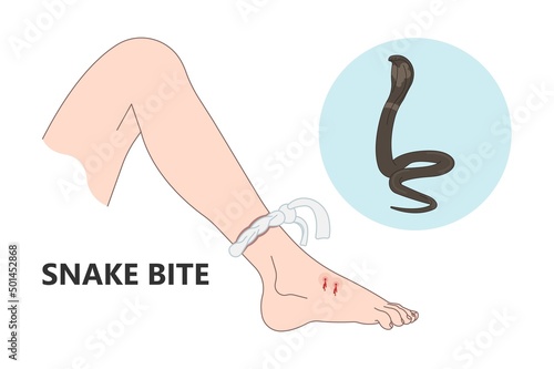 Snake Bite First Aid care non venomous anti venom serum hand leg king cobra treat kit death injury help safe call pain blood healing prevent coral fangs step poster grabbing splint limb sign tongs