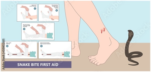 Snake Bite First Aid care non venomous anti venom serum hand leg king cobra treat kit death injury help safe call pain blood healing prevent coral fangs step poster grabbing splint limb sign tongs