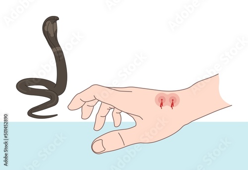 Snake Bite First Aid care non venomous anti venom serum hand leg king cobra treat kit death injury help safe call pain blood healing prevent coral fangs step poster grabbing splint limb sign tongs