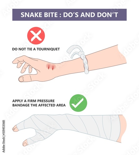 Snake Bite First Aid care non venomous anti venom serum hand leg king cobra treat kit death injury help safe call pain blood healing prevent coral fangs step poster grabbing splint limb sign tongs