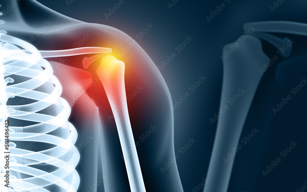 Human shoulder joint pain, xray view, shoulder ligament tendinitis, shoulder muscle strain. 3d
