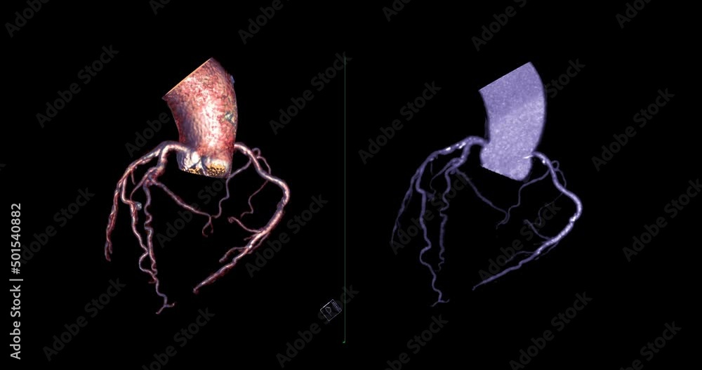 CTA Coronary artery 3D rendering turn around on the screen for ...