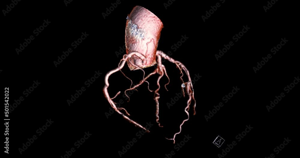 CTA Coronary artery 3D rendering turn around on the screen for ...
