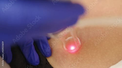 Laser cosmetic surgery and skin resurfacing in dermatology. Having a laser in a skincare clinic, a resurfacing technique for wrinkles, scars and solar damage to the skin